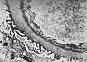 M,37y. | type I membranoproliferative glomerulonephritis (mesangiocapillary) M,37y. | type I membranoproliferative glomerulonephritis (mesangiocapillary)